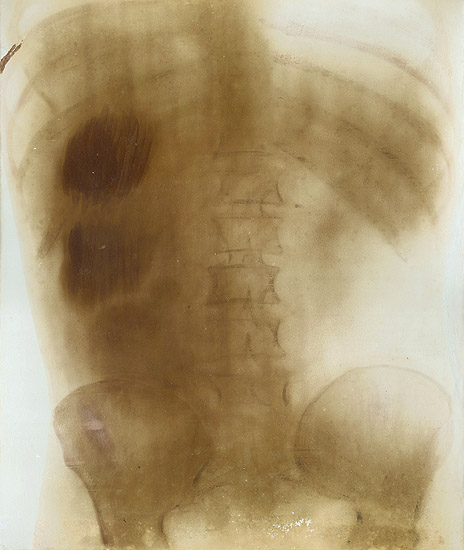 Photo Detail - Prof. Contremoulin (attributed to) - Large X-Ray of a Torso